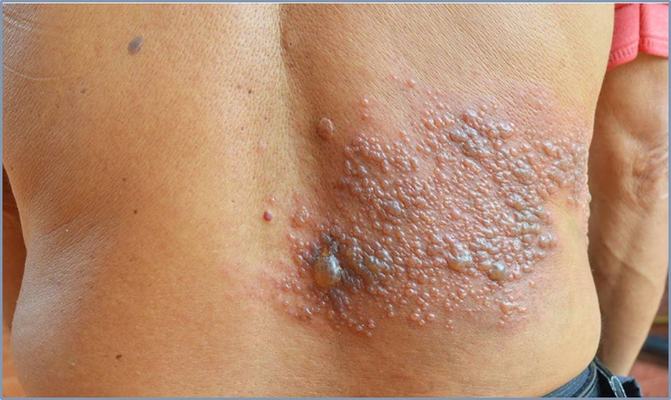 Herpes-zóster cresce entre jovens